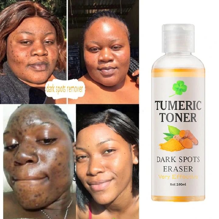 Quick Dark Spots Corrector Serum Tumeric Toner Acne Remover Fade Dark Spots Eraser Skin Care Serum 100ML Toner - MOOYAM - -
