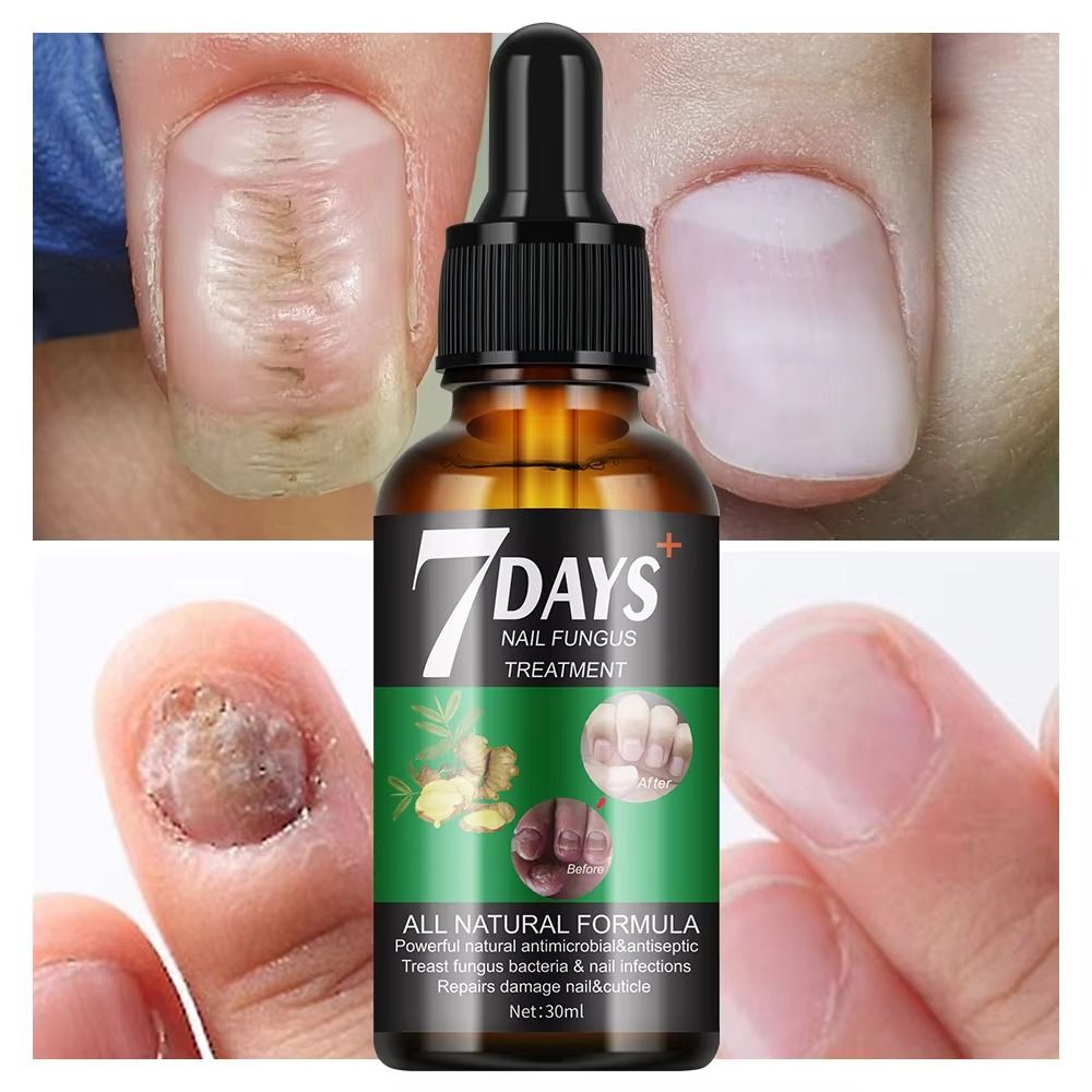 7 DAYS Fungal Nail Treatment Serum Foot Nail Fungus Removal Damaged Nail Repair Gel Anti Infection Paronychia Onychomycosis Foot Nails Care Essence - MOOYAM