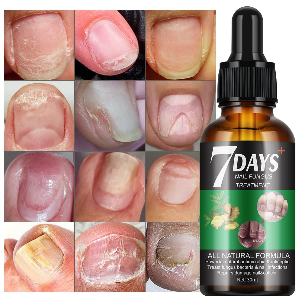 7 DAYS Fungal Nail Treatment Serum Foot Nail Fungus Removal Damaged Nail Repair Gel Anti Infection Paronychia Onychomycosis Foot Nails Care Essence - MOOYAM