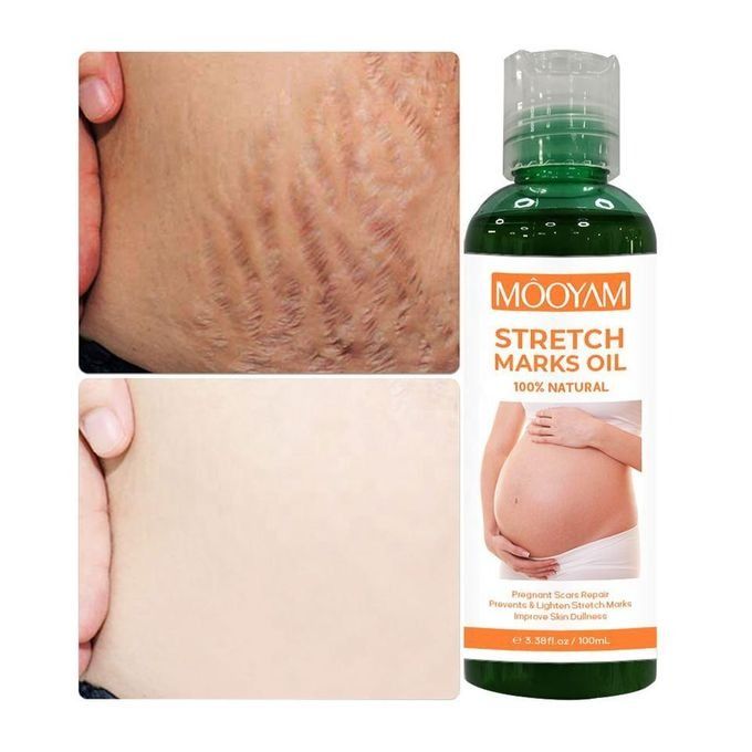100ML Stretch Mark Removal Oil Belly,Hands,Legs Marks Repairing Pregnancy Obesity Body Marks Removal Scar Moisturizing Repair Anti-Aging Anti-Winkles Cream Increase Skin Elasticity Smooth Firm -MOOYAM