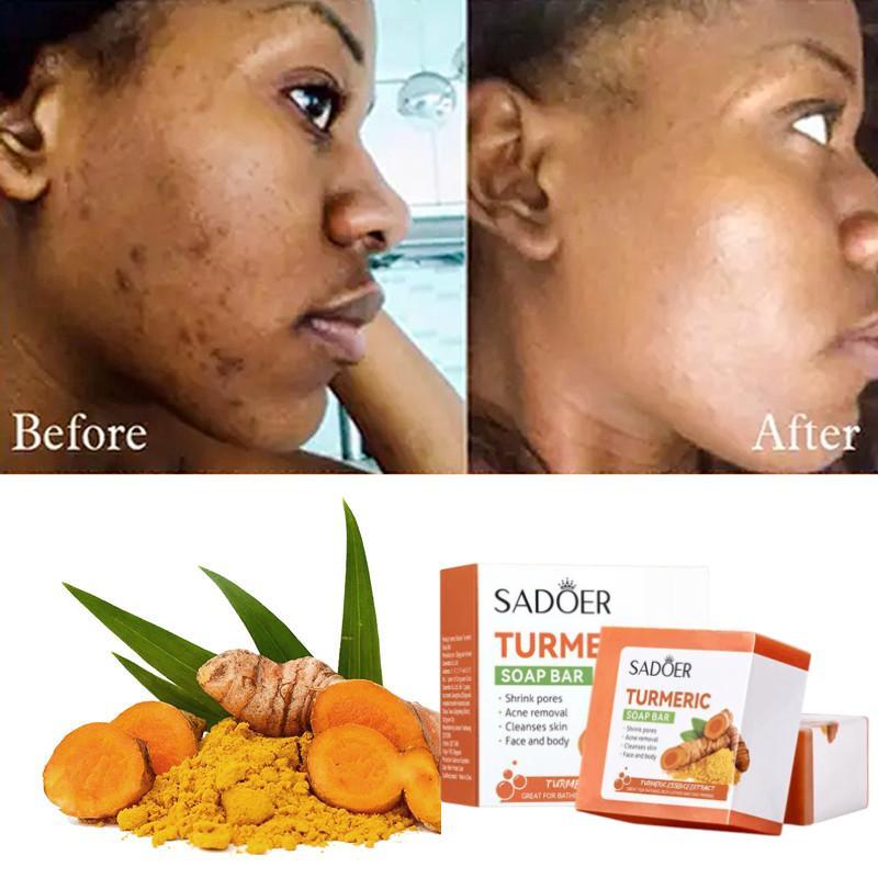 2 in 1,Tumeric Serum + Tumeric Soap Darks Spots Removal, Anti Acnes,Oil Control Face Brightening Blackhead Remover Set Pore Shrinking and Skin Tone Brightening - SADOER -