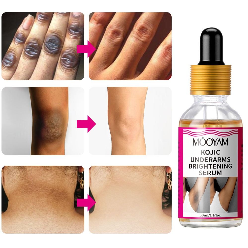 Whitening Darks Spots Remover Kojic Acid Serum Strong Brightening Armpits,Knees,Elbows Knuckles Whitening Spots Fine Lines Lighten Skin Tone Rejuvenating Antiage - MOOYAM -