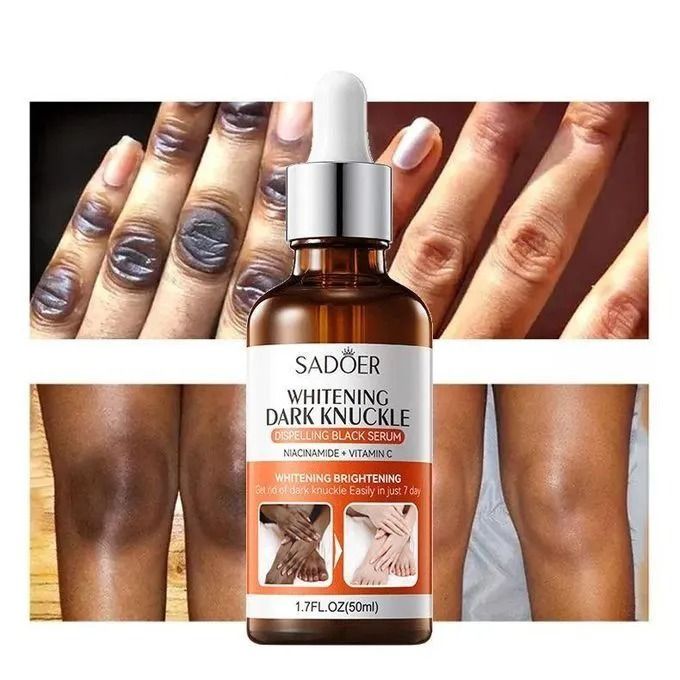 New Whitening Knuckles Remover Dark Spots Corrector Elbows,Knees,Fingers Whitener Lightening Whitening Serum  Dark Spot Removal Serum with Niacinamide & Vitamin C -SADOER-