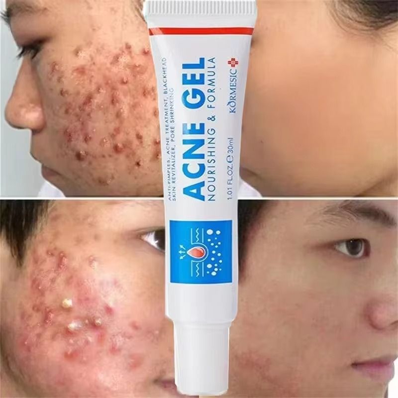 New Powerful Acne Removal Face Cream Clears Pimple Scar Black Dots Gel Treat Severe Acne Shrink Pore Whiten Skin Care Ointment - KORMESIC -
