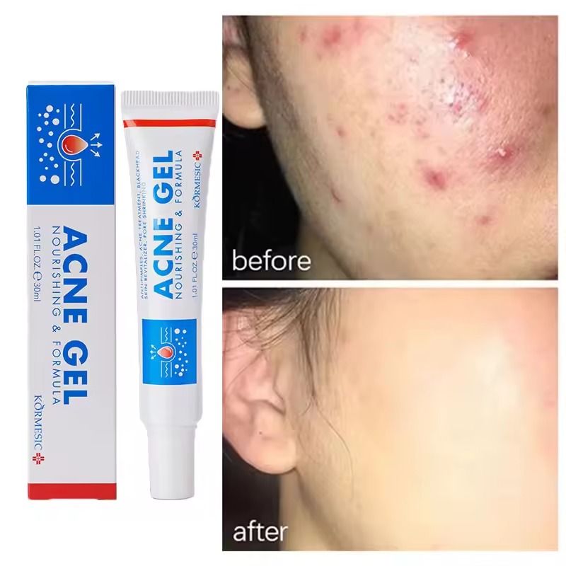 New Powerful Acne Removal Face Cream Clears Pimple Scar Black Dots Gel Treat Severe Acne Shrink Pore Whiten Skin Care Ointment - KORMESIC -