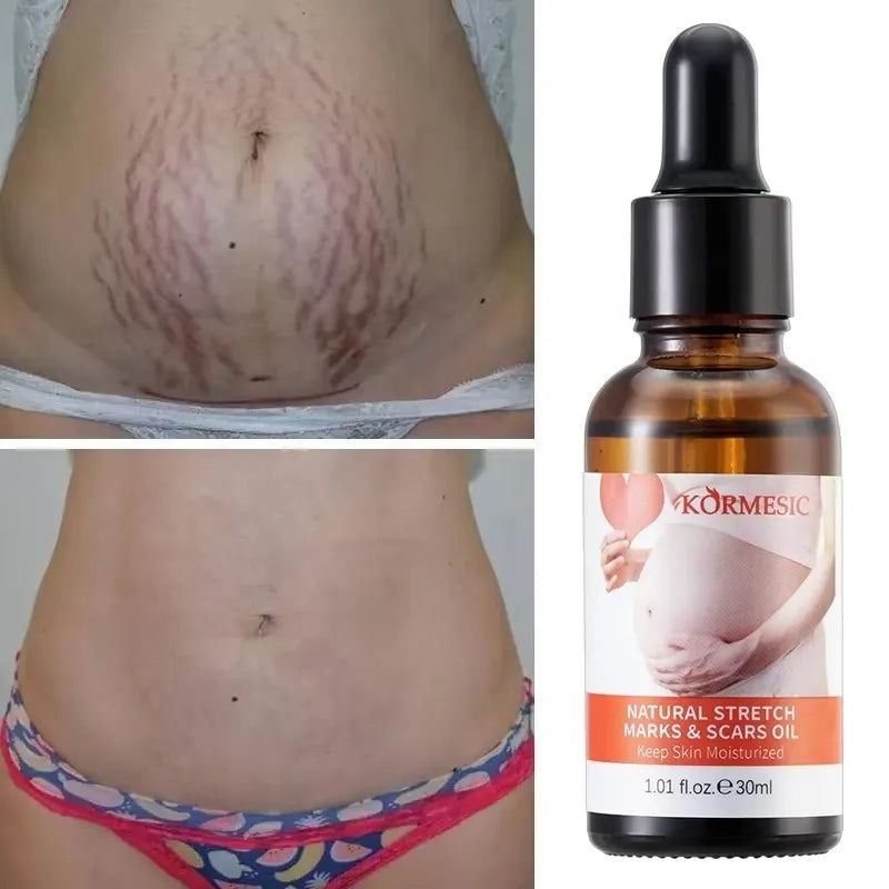 Stretch Marks Remover Skincare Body Oil Serum, Face and Body Moisturizer for Scars, Stretch Marks, Scars Repair, Abdominal Firming, and Gentle Stretch Marks Eradication  All Skin Types - KORMESIC -