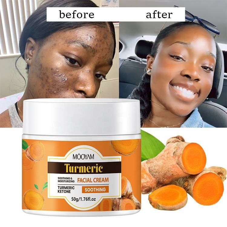 Turmeric Face Cream for Dark Spots – Natural Turmeric Skin Brightening Lotion for Face & Body – Cleanse Skin, Fight Acne, Even Tone, Clear Scars, Sun Damage, & Hyperpigmentation – 50g -MOOYAM-