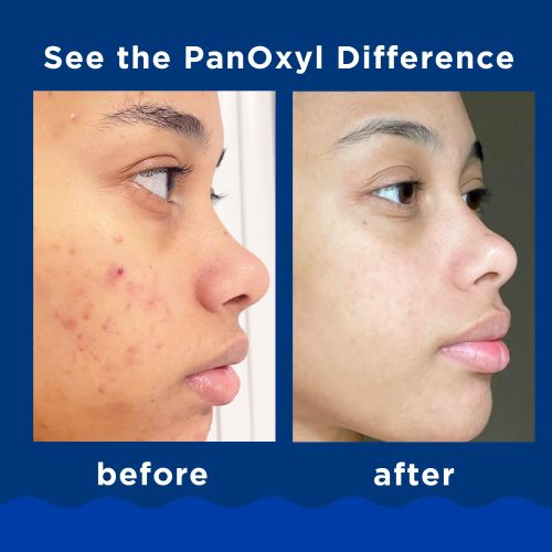 PanOxyl Acne Foaming Wash Benzoyl Peroxide 10% Maximum Strength Antimicrobial Clears existing acne blemishes clear glowing skin