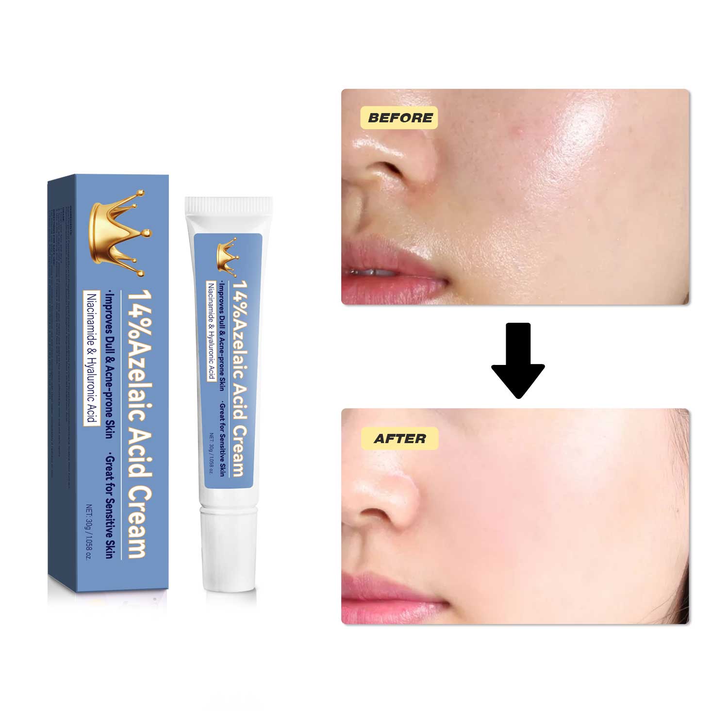 Lady Nian Dichloroacetate Cream 30g - Anti-Bacterial And Anti-Acne Skin Care Product