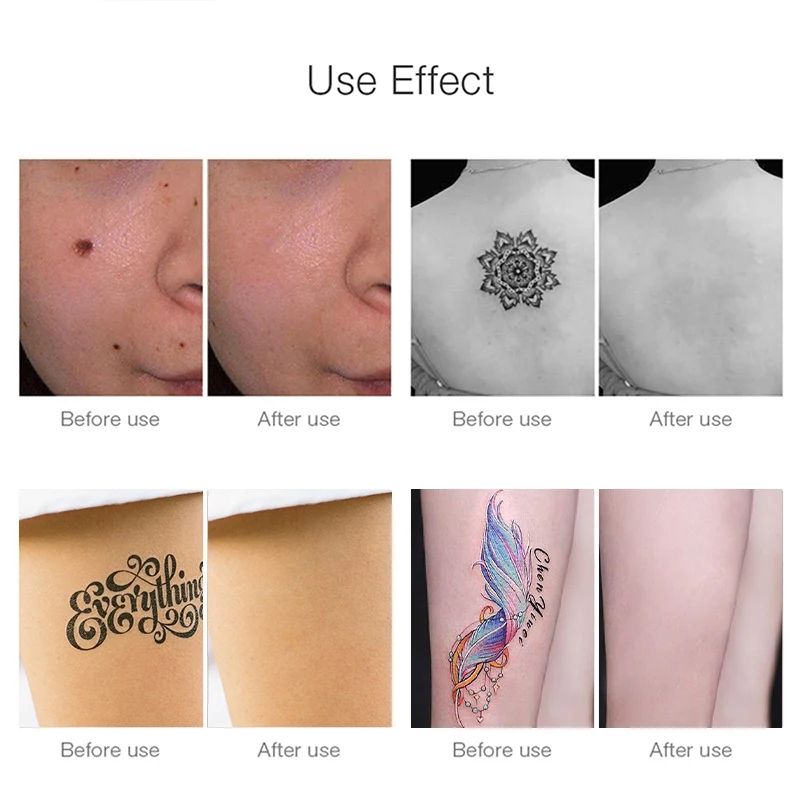 Professional Laser Picosecond Red &Blue Light Therapy Remover Dark Spot for Mole Removal Tattoo Skin Pigment Beauty Care Tool