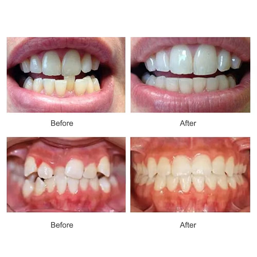 Dental Accessories 3 Stages Dental Braces Teeth Trainer Alignment Mouthpiece Tooth Orthodontic Brace Straightener For Adults