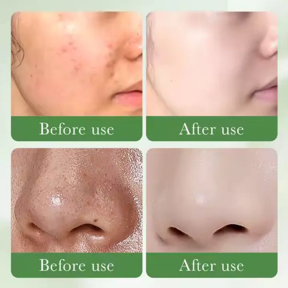 SADOER 2 in 1 Set, Acne Repair Serum with 3% Salicylic Acid Collagen Peptide and Niacinamide, Centella Asiatica + Turmeric Cream Anti-oxygen Tumeric, Can add Vitamin C,Remove Acne, Moisturize, Soothin