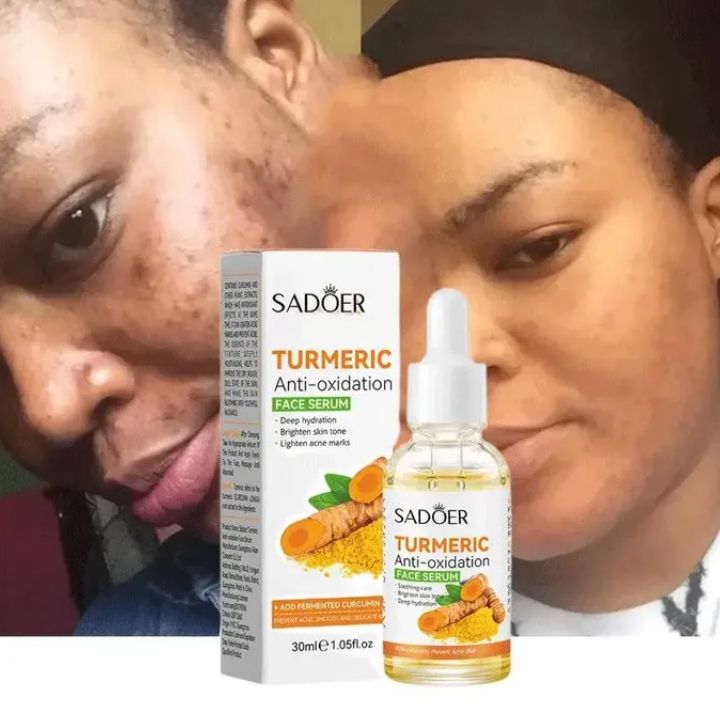 Sadoer Tumeric 3 in 1 Set, Turmeric Anti Acne Cleanser + Turmeric Face Serum + Tumeric Cream, Like Vitamin C, Guarantees Smooth Skin, Prevent Acnes, Control Oil, Remove Dark Spots , Moisturize, Refres