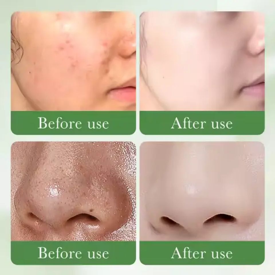 SADOER Face Cleanser, With 3% Salicylic Acid, Niacinamide & Centella Asiatica Collagen Acne Remover Facial Cleanser controls oils, Eliminates Acne, Removes Dirt Like Vitamin C, Smootrhens, Hydrate