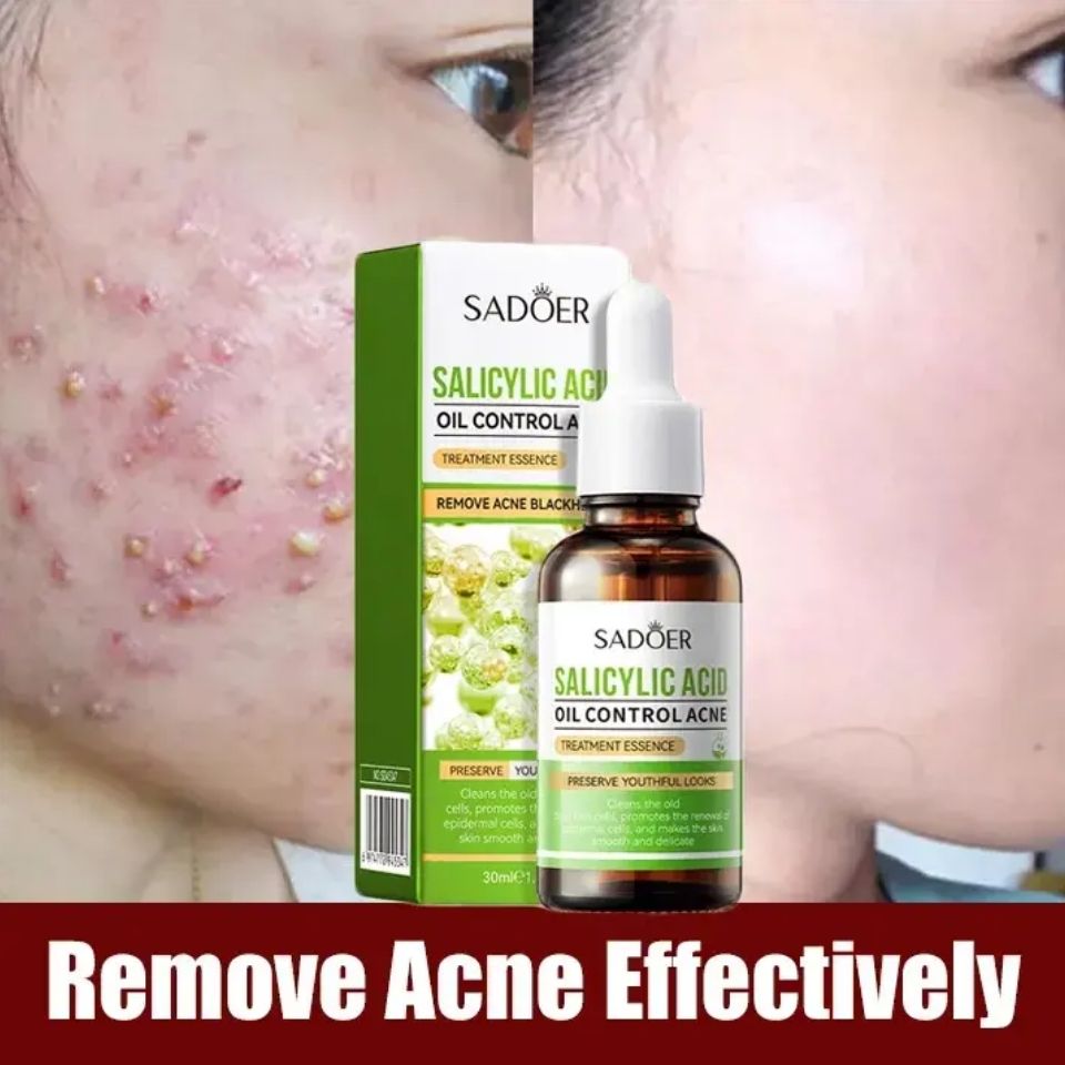 Acne Removal Salicylic Acid Face Serum Acne Treatment Repair Spots Scar Moisturizing Oil Control Shrink Pore Skin Care