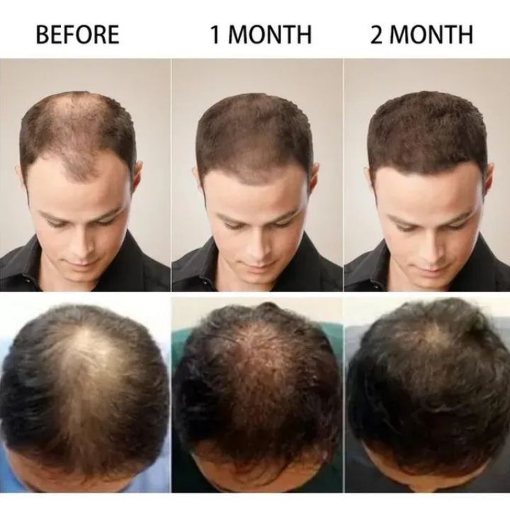 Sadoer Hair Care Serum, Ginger Hair Growth Based Product, Effective in Hair Growth,Moisturizing and Softening Forked Hair, with ScalpCare ingridients