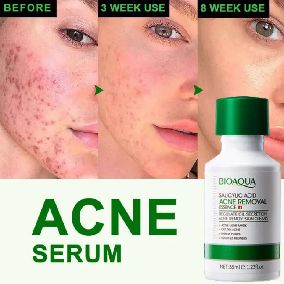 3 Pieces, Salicylic Acid Cleanser + Salicylic Acne Removal Cream (20g) + Salicylic Acid Acne Removal Essence, Shrink Pores, Eliminate Pimples, Can combine With Vitamin C, Regulate Oil Secretion, Clean