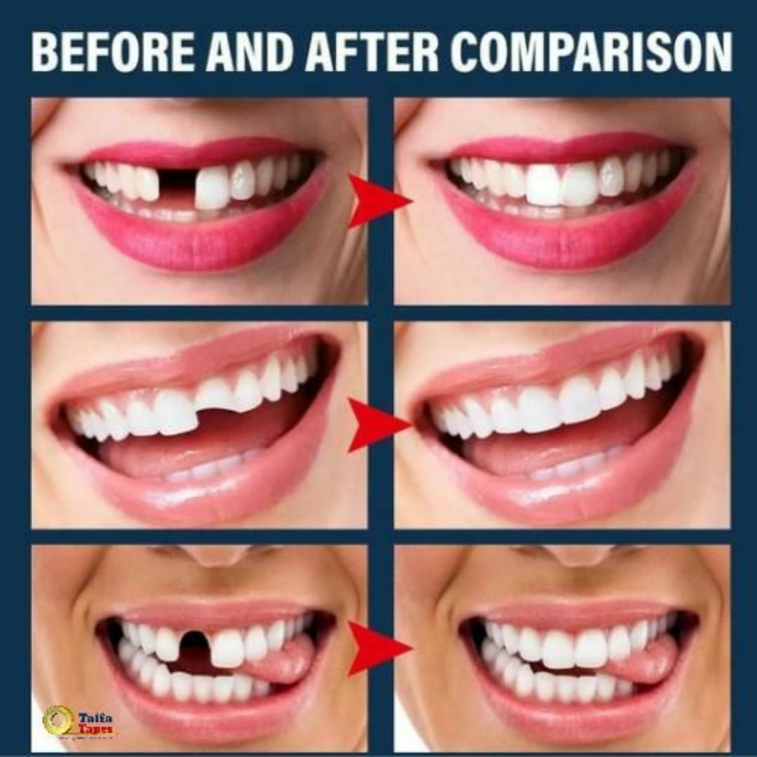 Eelhoe DIY Moldable False Teeth - 30ml Thermal Forming Temporary Tooth Replacement & Fillings - Instant Smile Repair - White Teeth