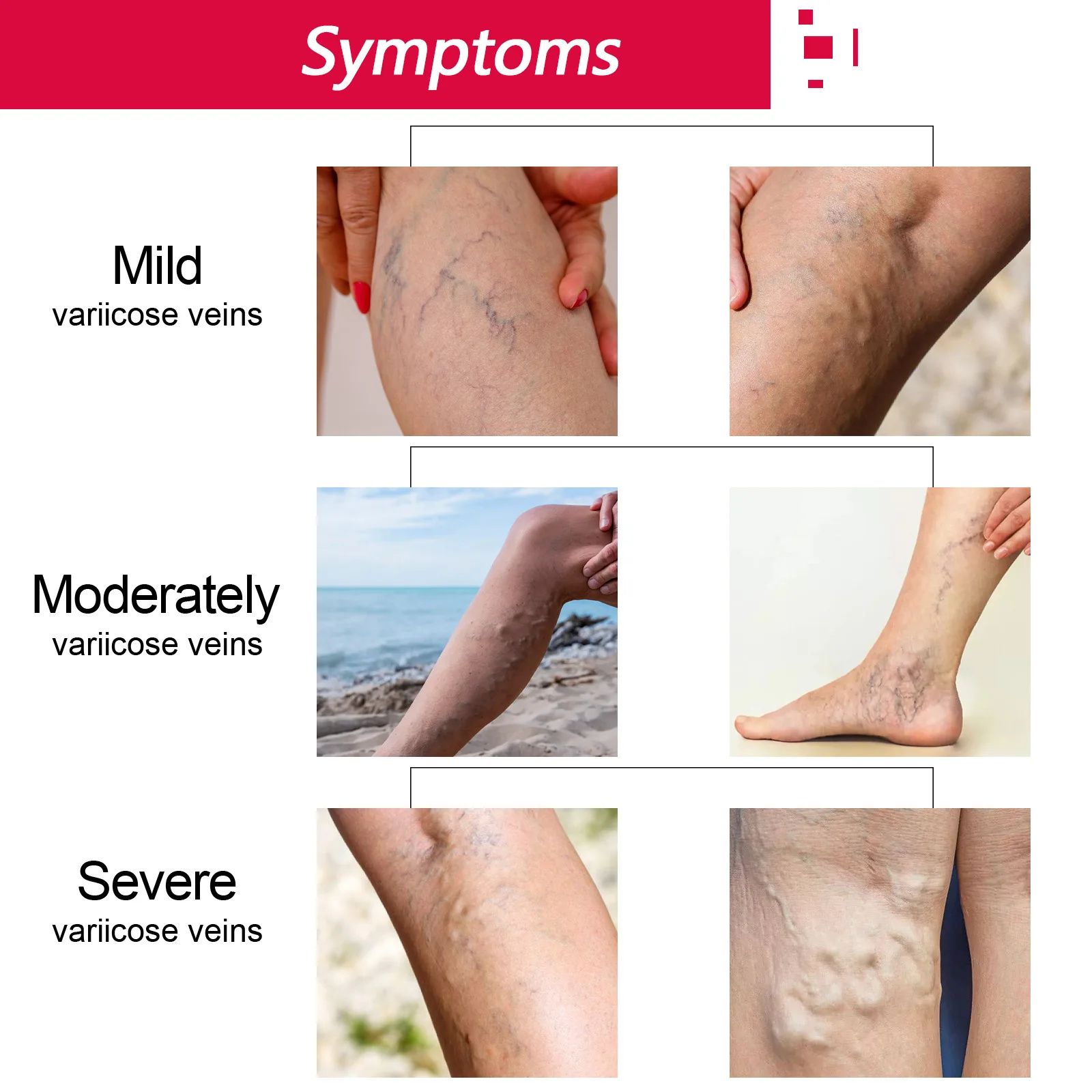 Rose Vein Care Essential Oil Improve Vasculitis Phlebitis Blood Circulation Lymphatic Leg Massage Care Varicose Vein Removal Oil