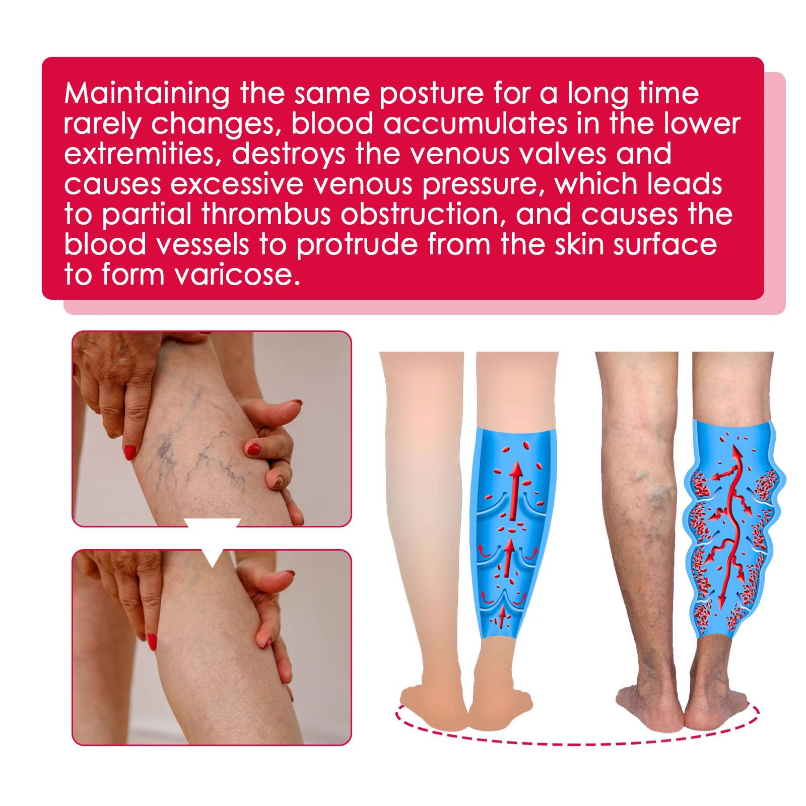 Rose Vein Care Essential Oil Improve Vasculitis Phlebitis Blood Circulation Lymphatic Leg Massage Care Varicose Vein Removal Oil