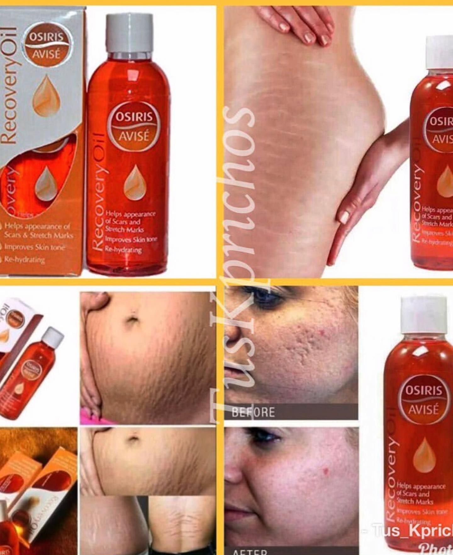 Osiris Avise Recovery Oil Helps Fade Scars, Stretch Marks, And Dark Spots, Promoting Smoother, More Even Skin Tone