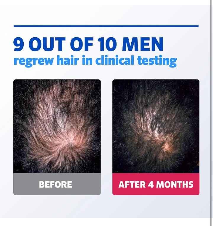 Free derma roller +Free Dropper + Men's Kirkland 5% Minoxidil solution for Hair Regrowth, Topical Hair Loss Treatment to Regrow Fuller, Thicker Hair, Unscented