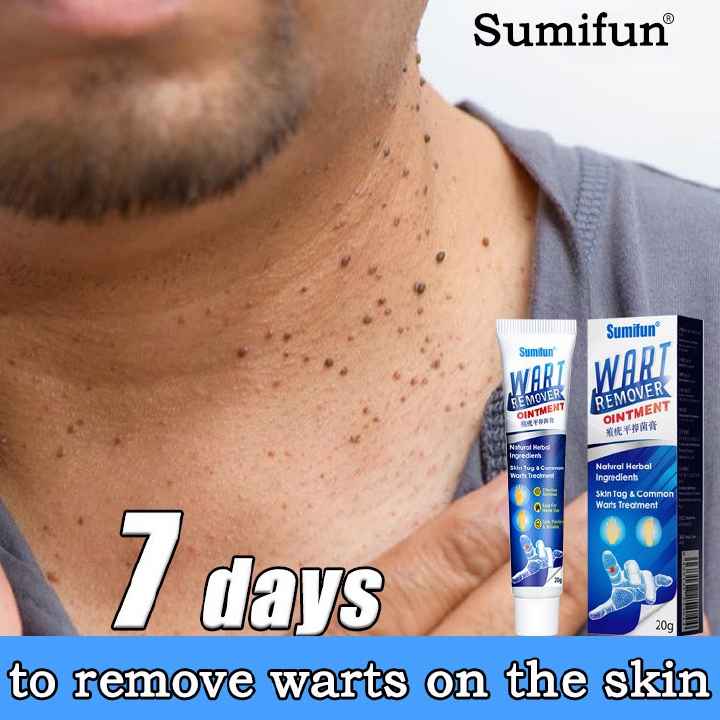 Original Warts Remover Ointment Skin Tag Removal Wart Treatment Cream Herbal Extract Foot Corn Antibacterial Warts Ointment- Sumifun