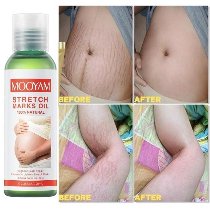 100ML Stretch Mark Removal Oil Belly,Hands,Legs Marks Repairing Pregnancy Obesity Body Marks Removal Scar Moisturizing Repair Anti-Aging Anti-Winkles Cream Increase Skin Elasticity Smooth Firm -MOOYAM