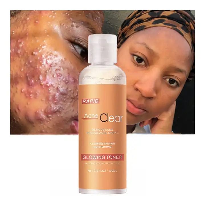100ML Salicylic Acid Acne Clear Oil Control  Skin Repairing Pore Shrinking Quick Remove Blackehead Elimination shrink Pores Tighten Face Anti Acne Treatment Toner -MOOYAM -