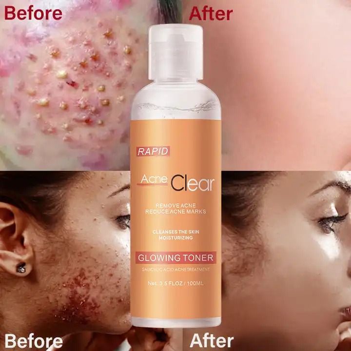 100ML Salicylic Acid Acne Clear Oil Control  Skin Repairing Pore Shrinking Quick Remove Blackehead Elimination shrink Pores Tighten Face Anti Acne Treatment Toner -MOOYAM -