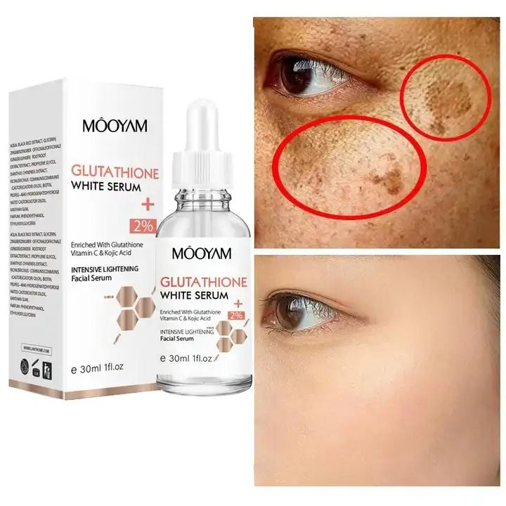 Glutathione Serum Remove Melasma Dark Spot Dilute Serum With Kojic Acid Moisturizing Essence Vitamin Face Whitening Reduce Pigmentation Fade Black Spot Dead Skin Lightening Brightening Face Glowing -