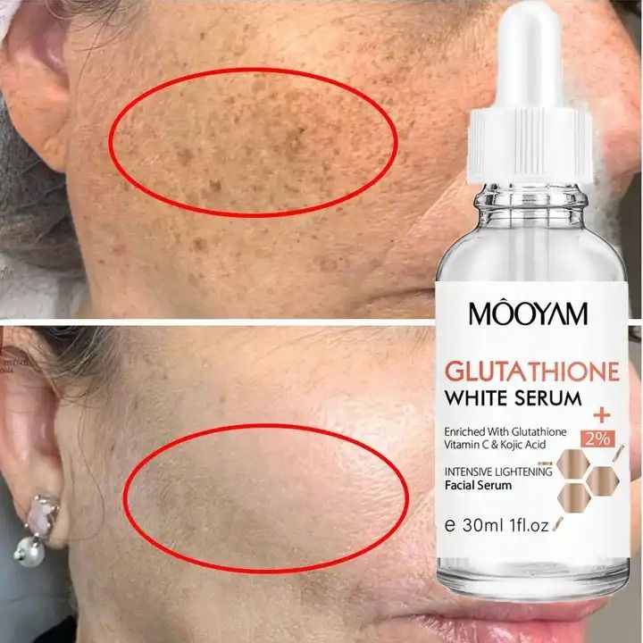 Glutathione Serum Remove Melasma Dark Spot Dilute Serum With Kojic Acid Moisturizing Essence Vitamin Face Whitening Reduce Pigmentation Fade Black Spot Dead Skin Lightening Brightening Face Glowing -