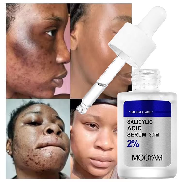 30ml Salicylic Acid Delicate Pore Acne Remover Oil Control Dark Spots Facial Essence Hydrating Moisturizing Gentle Care Shrinking Pore Water Light Beauty Face Serum- MOOYAM -