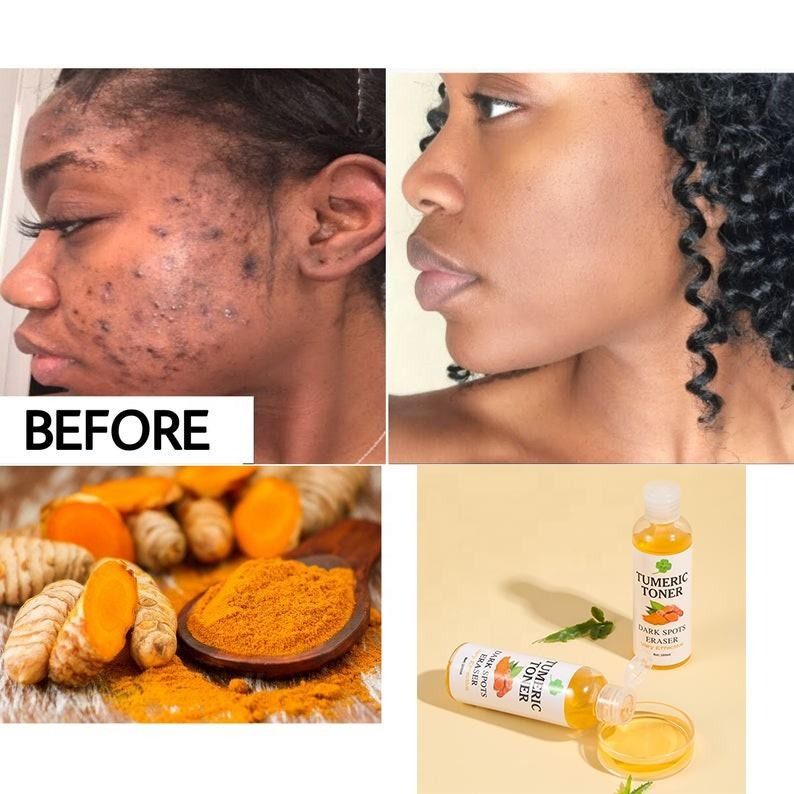 【hot sale】100ml Dark Spots Removal Turmeric Facial Toner Acne Pimple Remover Fade Melanin Anti-aging Remover Acne Brighten Essential Liquid Face Care Products -