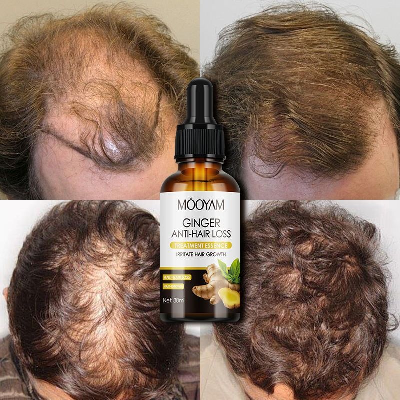 Quick Ginger Hair Growth Oil Roots Grow Anti Hair Loss Hair Regrowth Serum Scalp Damaged Repair Nourish Care Products Women Men - MOOYAM -