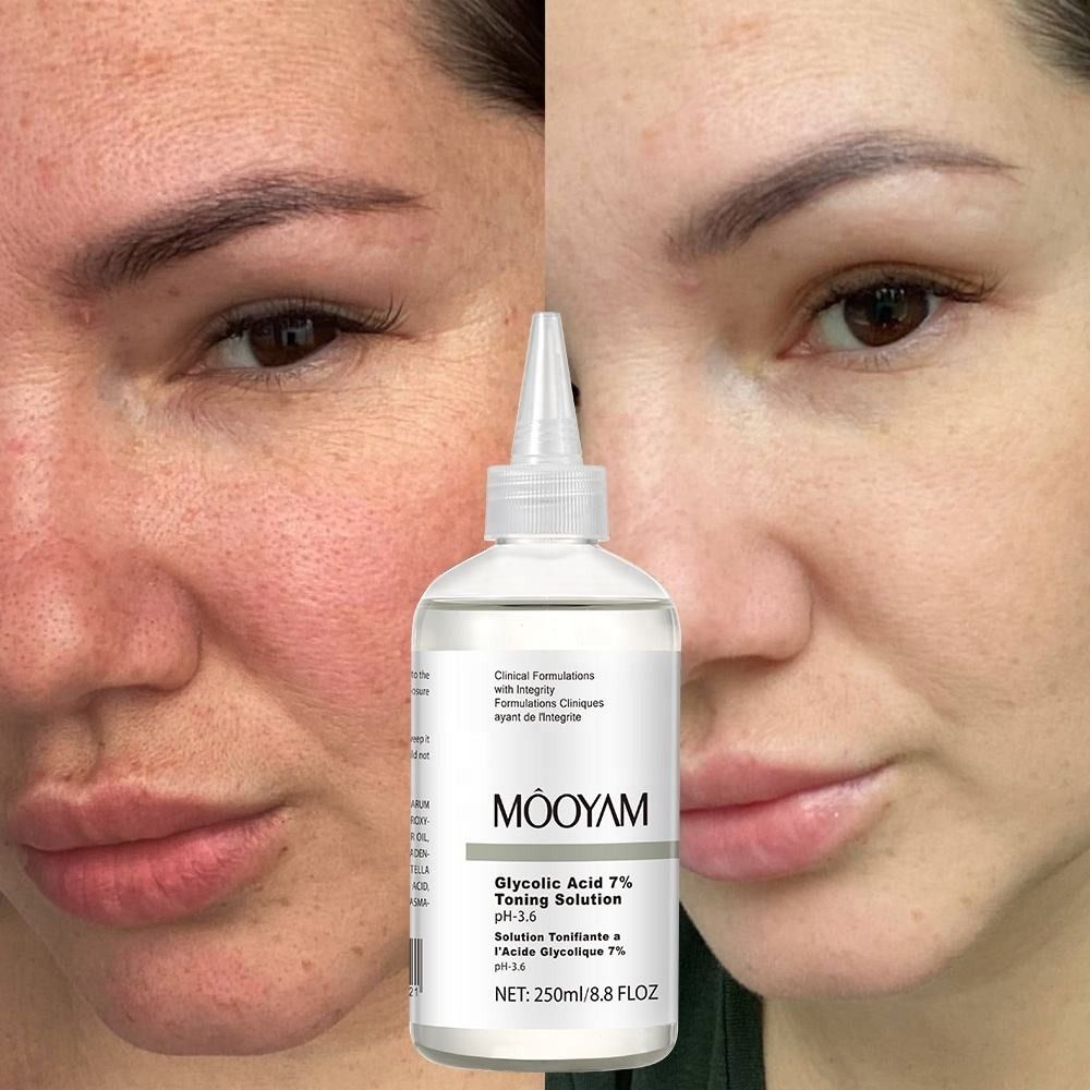 250ML Glycolic Acid 7% Toning Solution Glycolic acid toner gentle Exfoliator Improve dullness skin Remove blackheads Acne Clear Anti-acne fruit acid serumPimple Dark Spot Marks Remover - MOOYAM -