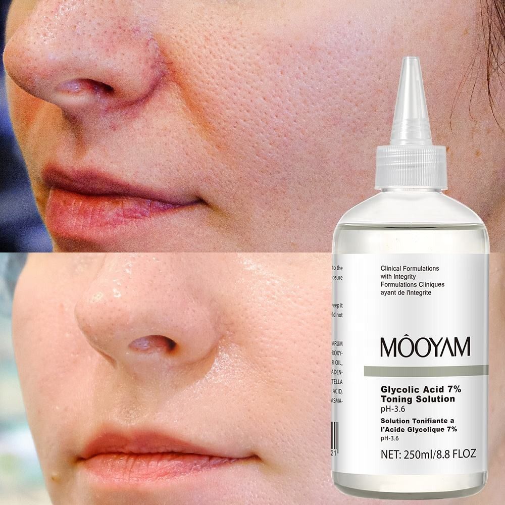 New Glycolic Acid 7% Toning Solution,Restores Skin Vitality and Refreshing, Remove Acne Fade Acne Fruit Acid Essence Moisturizes The Face, Spot Marks Remover, Suitable for Daily Use - MOOYAM -