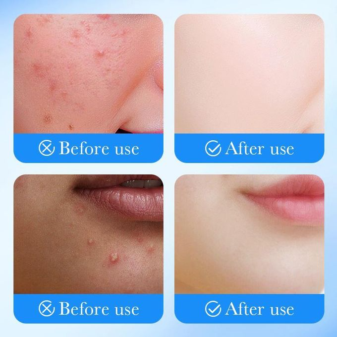 Pimple Patch Repair Acne Patch Facial Skin Care Fade Blemishes Pimple Marks Closed Acne Blemishes Cover Acne Pimple Repair Patch Skin Acne Removal Patch Invisible Beauty Stickers -SADOER-