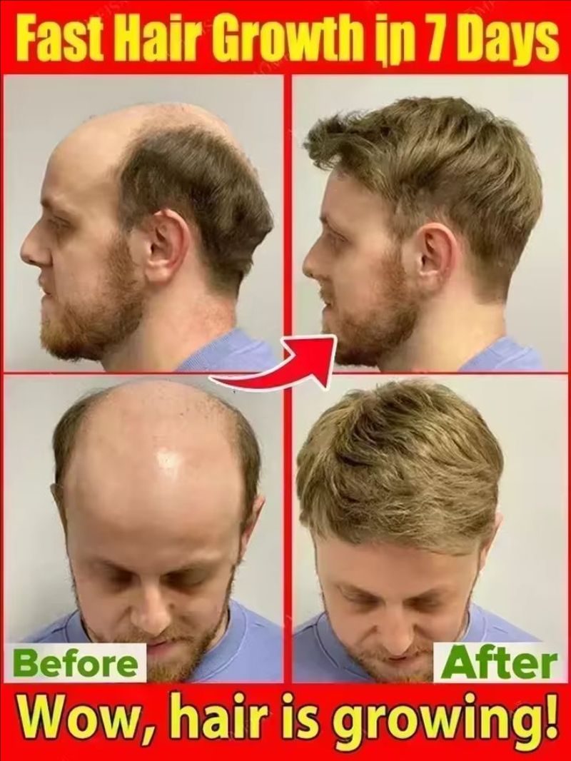 Hair Growth Essential Loss Regrowth Treatment Strengthens Hair Nourishes Scalp Light Weight Non Greasy Improve Scalp Circulation