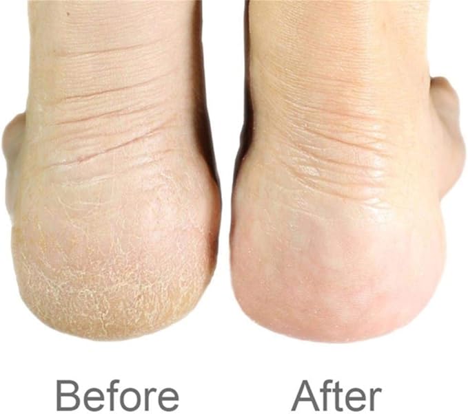2 Pcs-1 pc  Wooden Foot File Professional Foot File Callus Remover - Wooden Foot Scrubber Filer For Dead Skin & 1 pc Stainless Steel Foot Exfoliating Scrubber  File Foot rasp Foot File Callus Removet