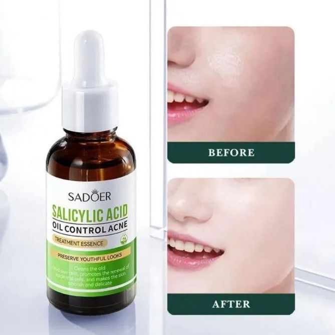 2 Piecs -Vitamin C Face Brightening Serum And Salicylic Acid Acne Treatment Essence, Control Face Oil and removes Blackheads, Brightens Face, Fades Black Spots, Moisturize Face, Anti Wrinkles