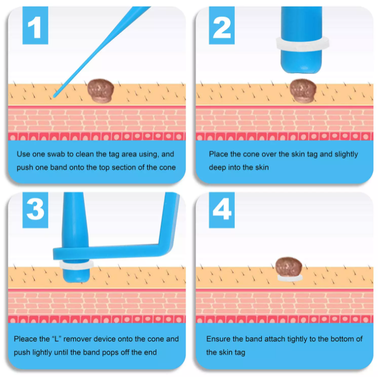 1 Set Skin Tag Removal Kit Home Use Mole Wart Remover Equipment Micro Skin Tag Treatment Tool Easy To Clean Skin Care Tool