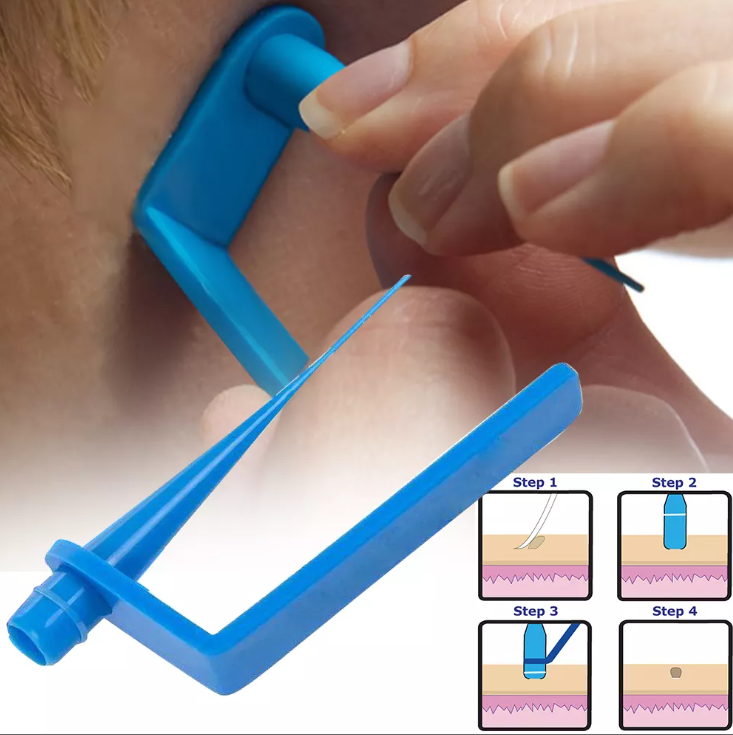 1 Set Skin Tag Removal Kit Home Use Mole Wart Remover Equipment Micro Skin Tag Treatment Tool Easy To Clean Skin Care Tool