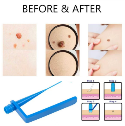 1 Set Skin Tag Removal Kit Home Use Mole Wart Remover Equipment Micro Skin Tag Treatment Tool Easy To Clean Skin Care Tool