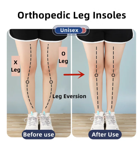 1Pair Silicone Gel Orthopedic Insoles for Feet Magnet Massage Insole