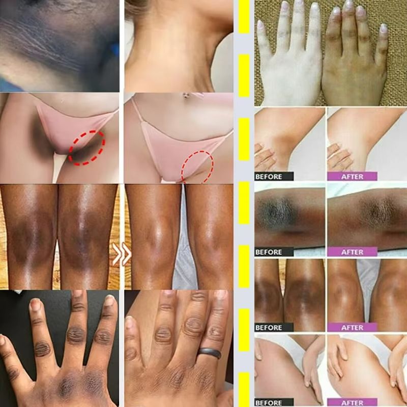 SADOER Snow Bleach Cream Private Parts Whitening Cream Underarm Bleaching Serum Whiten Butt Knee Brighten Inner Thigh Intimate Parts Dark Remove Melatonin Whitening Cream Brightens Body Lotion