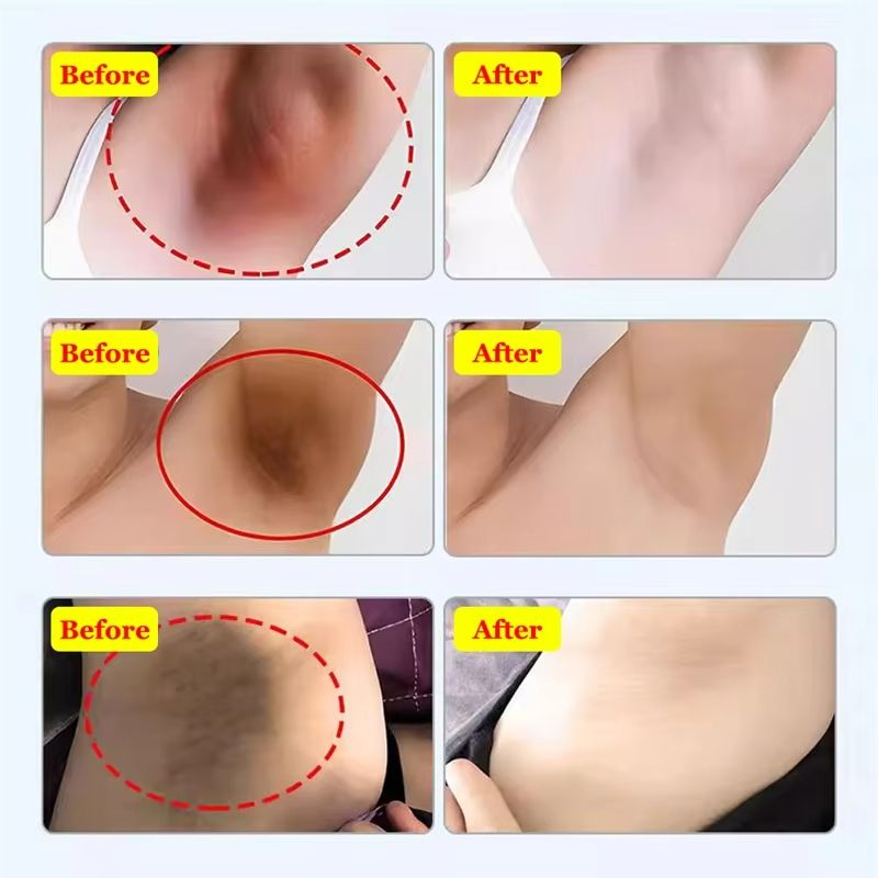 SADOER Snow Bleach Cream Private Parts Whitening Cream Underarm Bleaching Serum Whiten Butt Knee Brighten Inner Thigh Intimate Parts Dark Remove Melatonin Whitening Cream Brightens Body Lotion