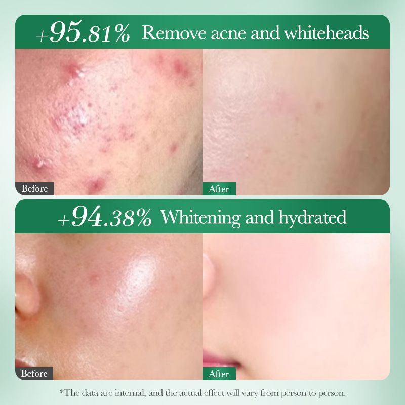 SADOER Salicylic Acid Face Cream Niacinamide Tea Tree Whitening Anti-Acne Facial Cream Moisturizing Exfoliating Hydrating Care Face Essence Skin Repair Cream