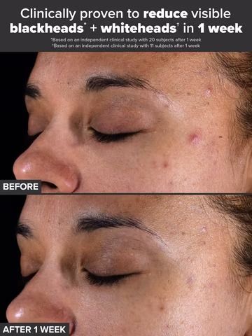 Paulas Choice skin perfecting 2% BHA Liquid Exfoliant with Salicylic Acid. Removes Blackheads, Blemishes, Whiteheads, Wrinkles, Unclogs Pores, Smoothes, Evens, Oil Control, Exfoliates & Glows 118ml