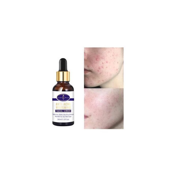 Aichun Beauty Anti-acne Whitening Serum Face Serum Medical Formula, 30ml Anti-Acne Whitening Brightening Anti-aging Skin Care Face Serum Anti Acne 3-ml